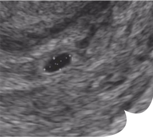 grossesse echo 4sa 300x269 - Le bébé, semaine après semaine grossesse 1er mois