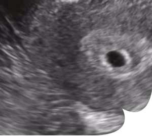 grossesse echo 5sa 300x269 - Le bébé, semaine après semaine grossesse 1er mois
