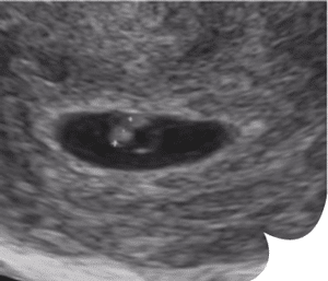 grossesse echographie bébé 4ème seaine 6 SA