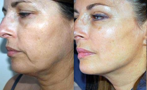 French Lift Chirurgie esthétique visage