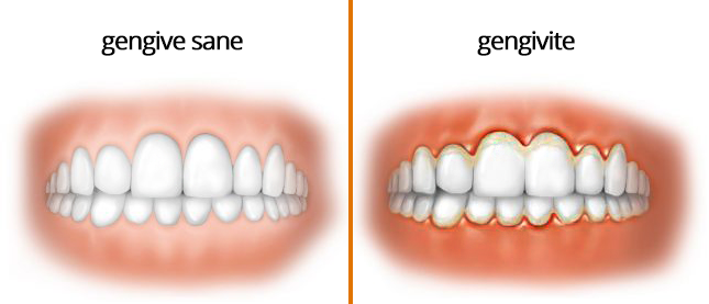 gingivite de grossesse