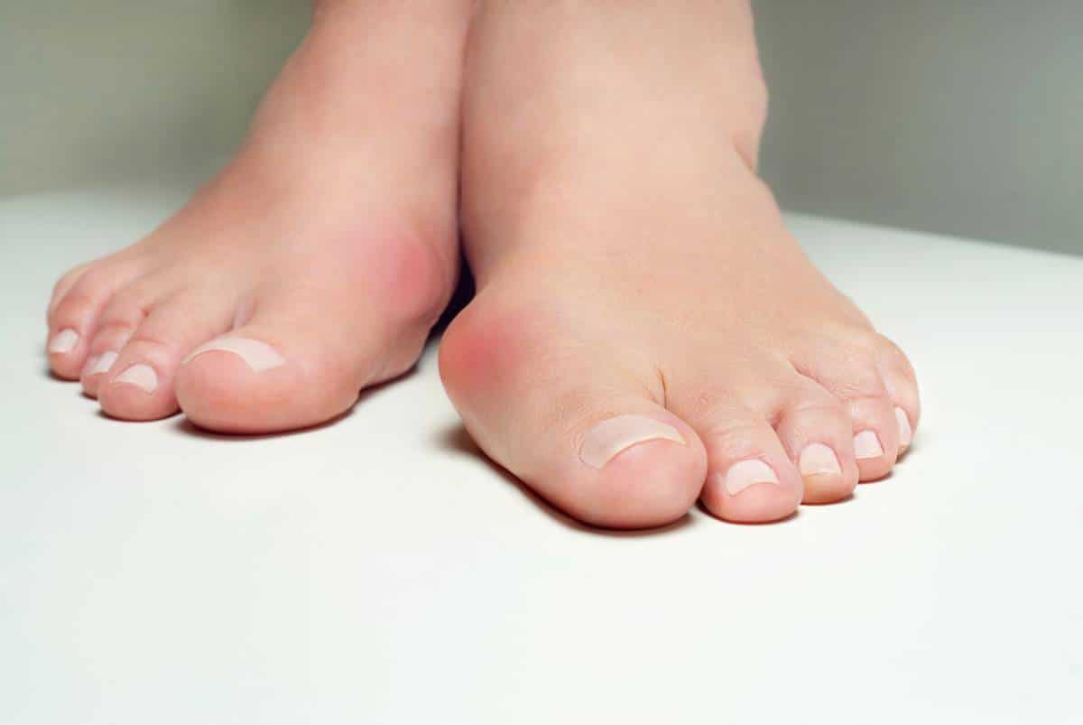 Tout savoir sur l’hallux valgus