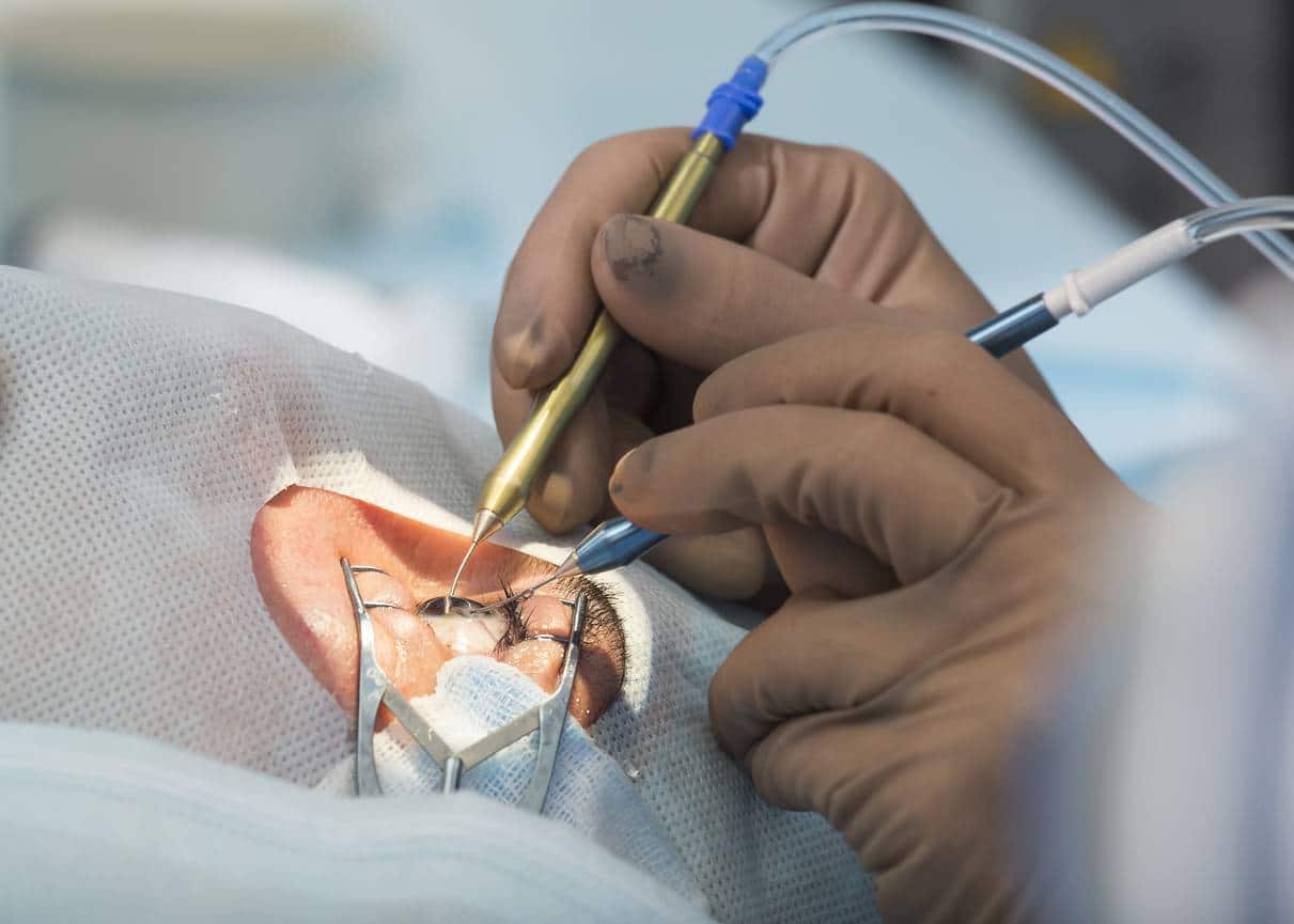 coût chirurgie réfractive