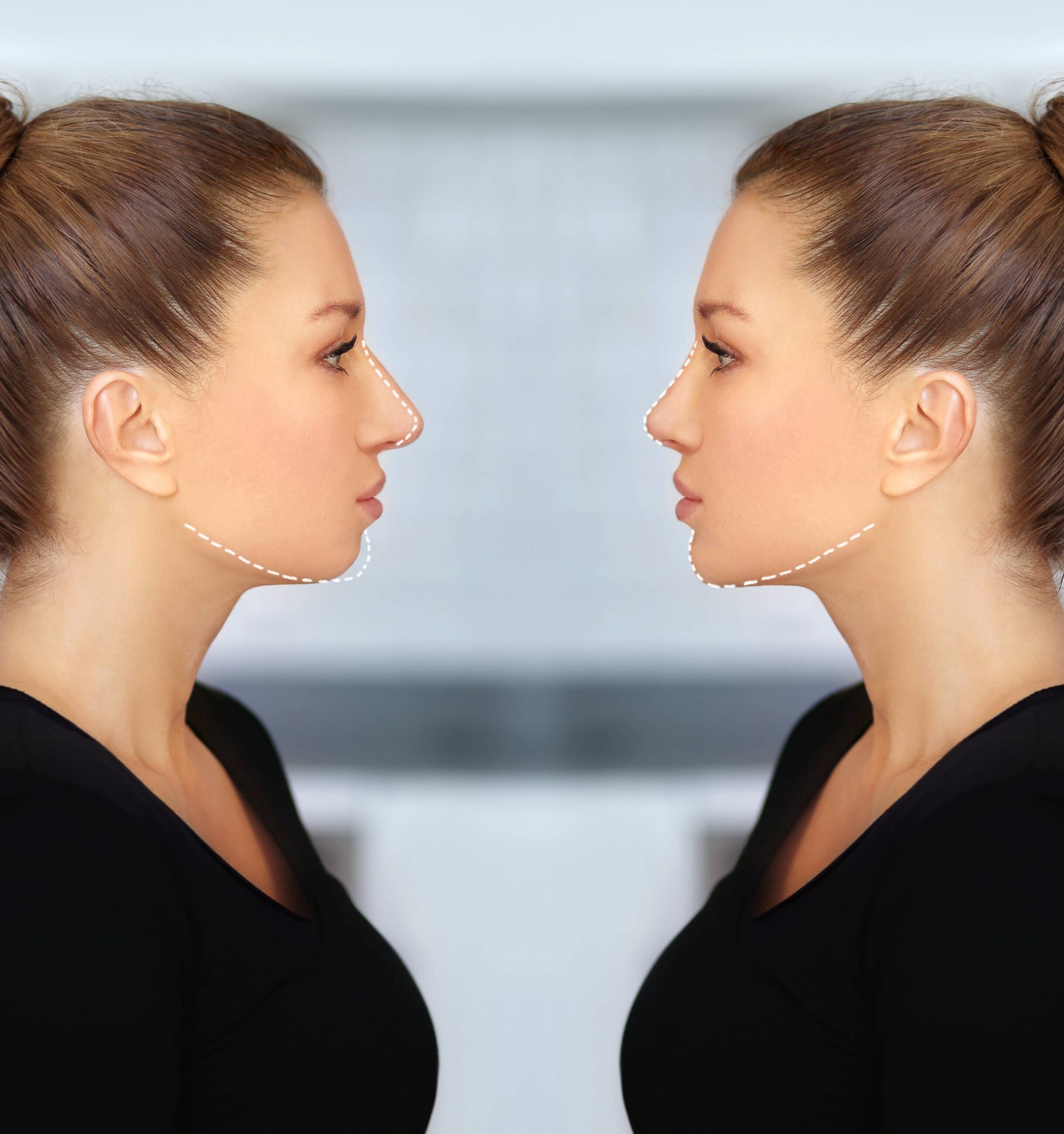 "rhinoplastie avant-après