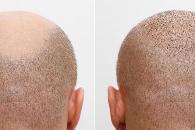 un-homme-ayant-implants-cheveux