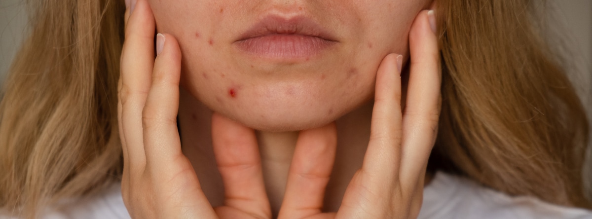 cicatrices acne solutions traitements prevention