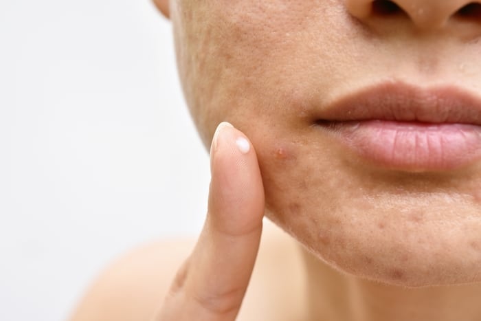 Problème de peau d'acné et de visage, femme appliquant une crème contre l'acné