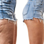 Causes de la cellulite sur les cuisses dune femme avant apres
