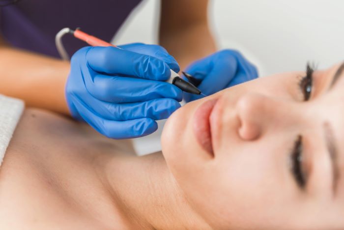 Une femme qui fait une une electrolyse pour une epilation definitive