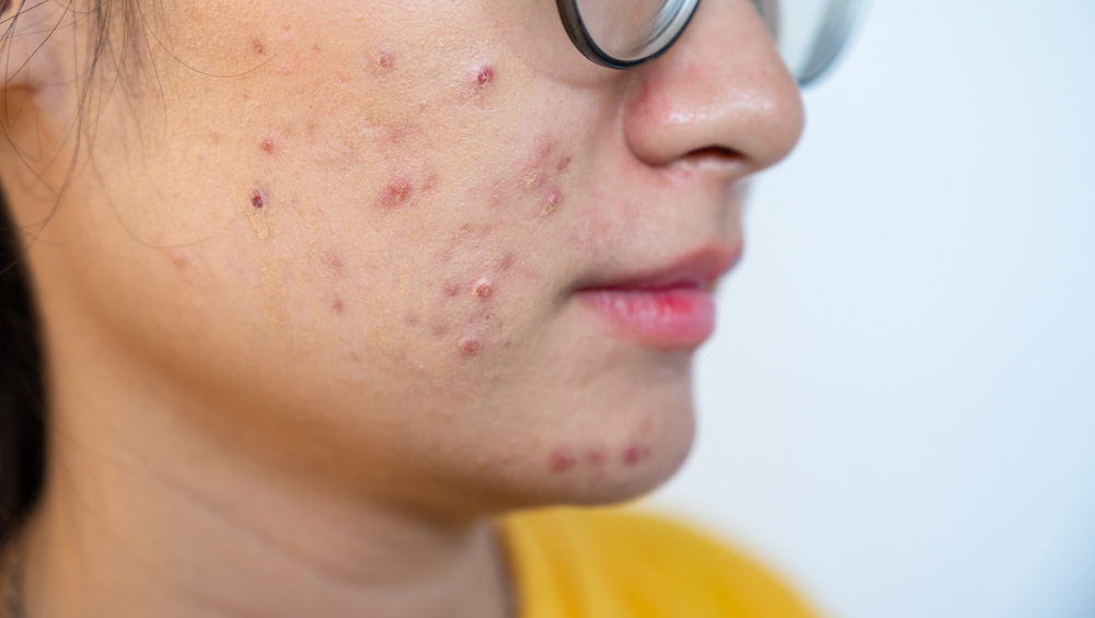 Vue rapprochée d’une peau avec acné inflammatoire Peau avec acné sévère et excès de sébum sur les joues et le menton chez une jeune femme
