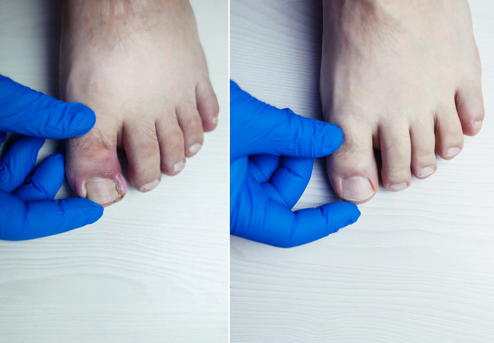 Comparaison avant après d’un ongle de pied épaissi suite à un traitement podologique