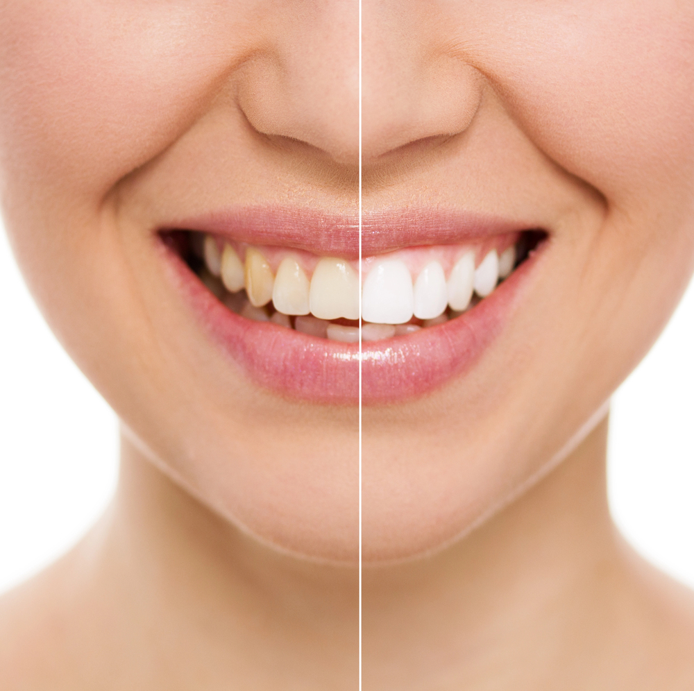 Sourire féminin avant et après un blanchiment dentaire