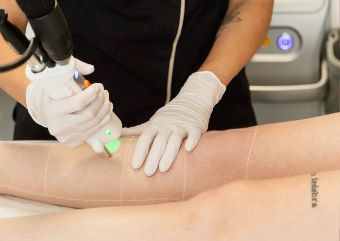 Séance d’épilation laser sur le bras d’une personne dans un centre esthétique médicalisé © CtrlZ